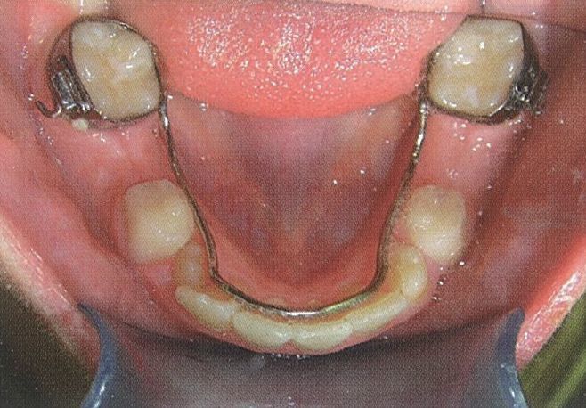 可制作nance弓保持器; 双侧下颌第二乳磨牙早失,可制作舌弓间隙保持器