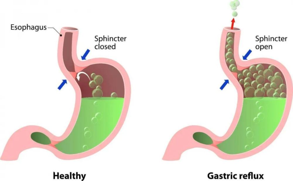 1 胃食管反流病有什么症状 它是指胃里面的胃酸,胆汁等反流进入食管