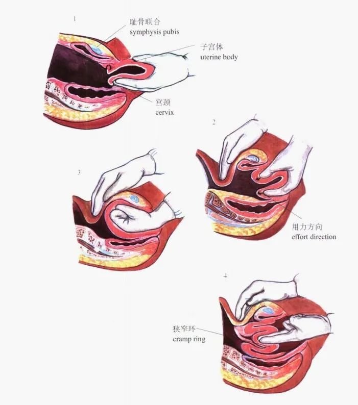 妇科手术图解30:子宫内翻经阴道徒手复位术