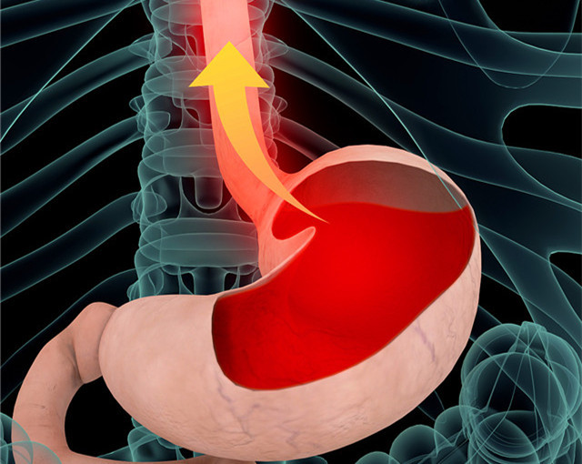 为什么经常发生胃反酸,甚至睡觉时被反酸呛醒,看医生的专业分析