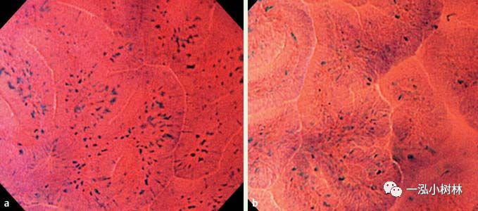 早期胃癌超细胞放大内镜图片