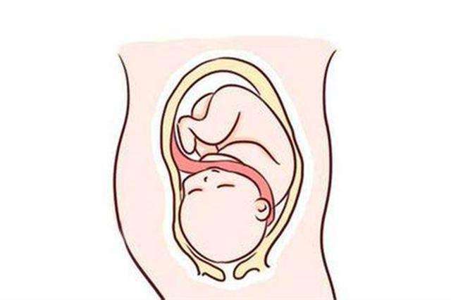 如果脐带绕颈1周的,彩超下胎儿颈部呈现u形的压迹,并且可见一个小