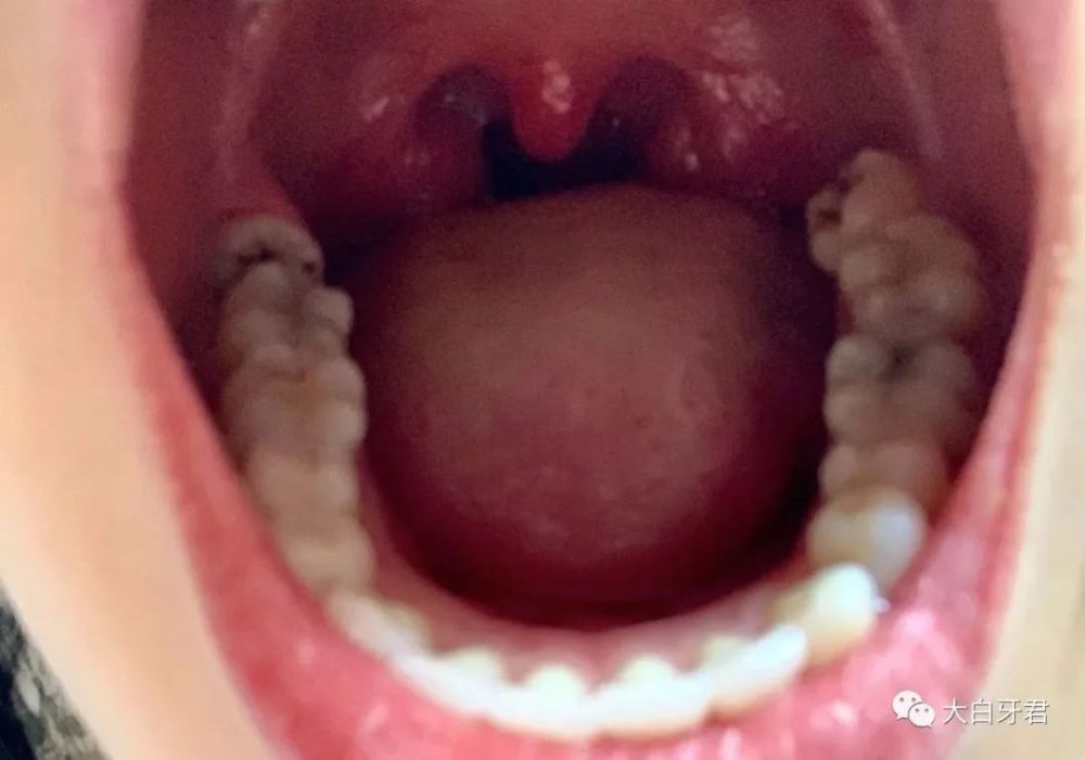 疫情,口腔科,哺乳期,何剑亮,牙髓炎