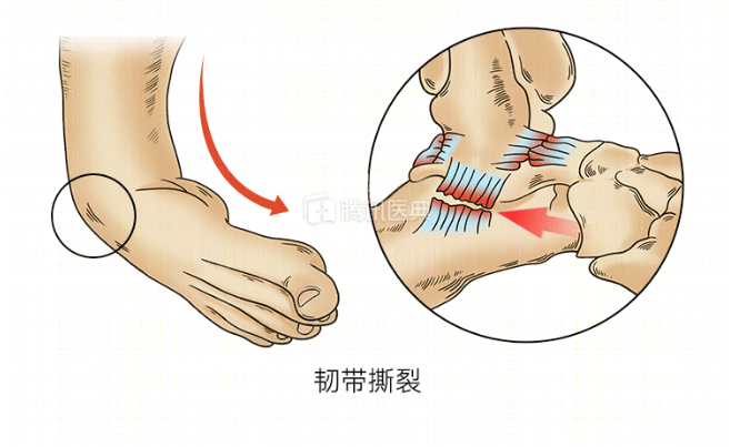 韧带断裂的同时,血管也会破裂出血,所以,崴脚以后踝关节会有肿胀和
