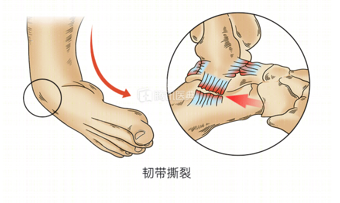 崴脚,冰敷,踝关节,韧带撕裂,关节肿胀