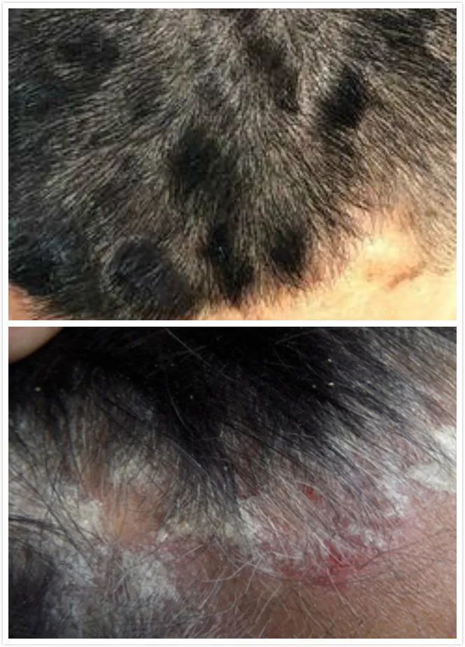 目前,在临床治疗方面,外用药物治疗头皮银屑病是目前常用的治疗方法