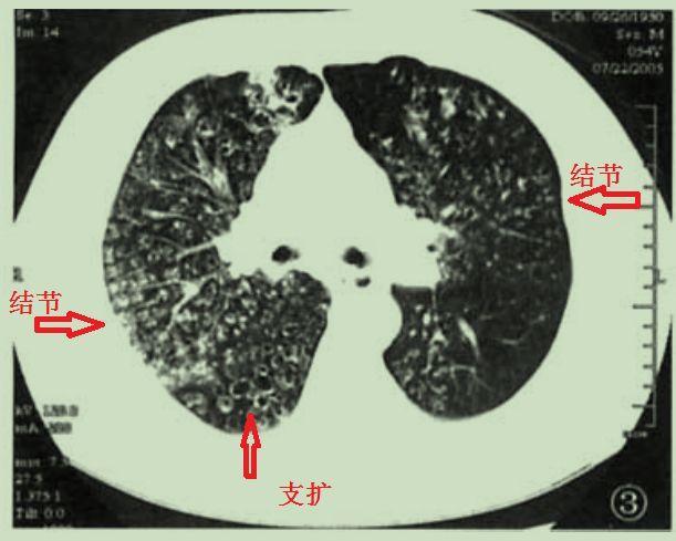 也证实了他有严重的鼻窦炎,于是我想到了一个疾病,弥漫性泛细支气管炎