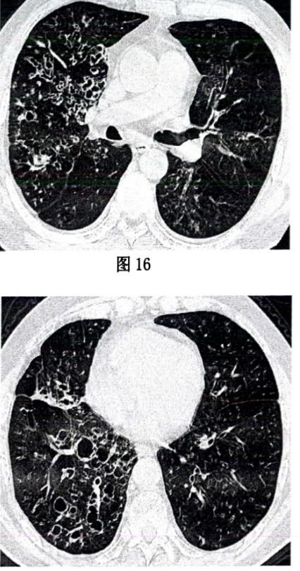 他被诊断为支气管扩张5年,肺已经千疮百孔,我为他找到