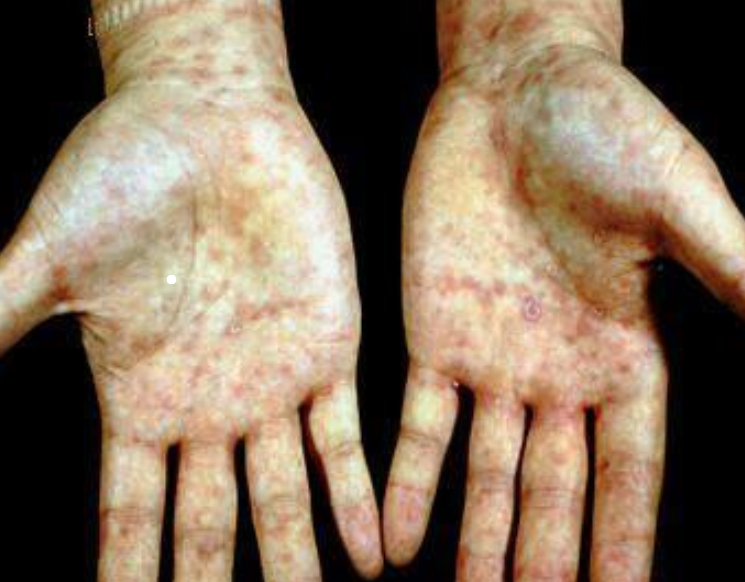 据了解,有89%的患者皮肤中有白色念珠菌感染,所有感染的人皮肤就会