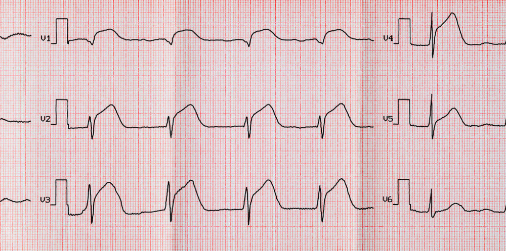 临床心电图:st段抬高的常见病因分析及处理