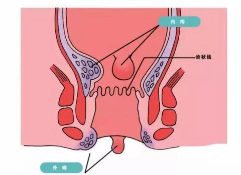 内痔,痔疮,肛门,直肠