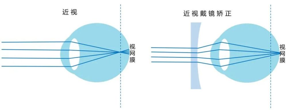 近视是人眼看到的物体成像在视网膜的前端.