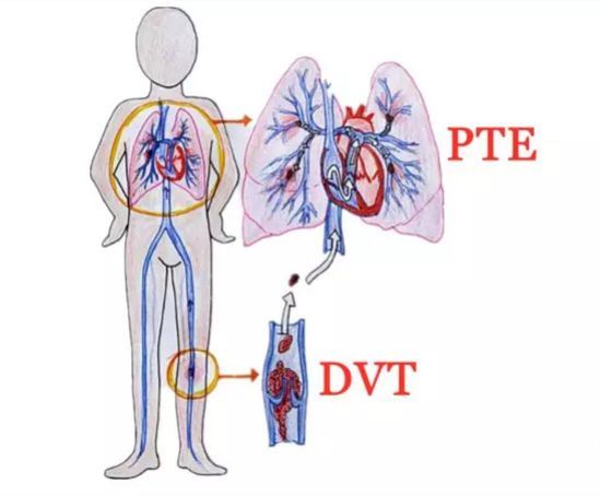 静脉血栓,栓塞,血栓,下肢,下肢静脉血栓