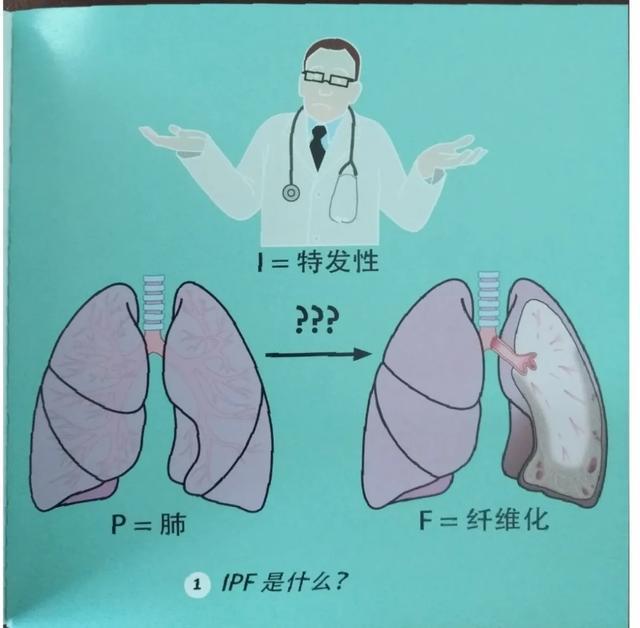 一起了解"特发性肺纤维化"