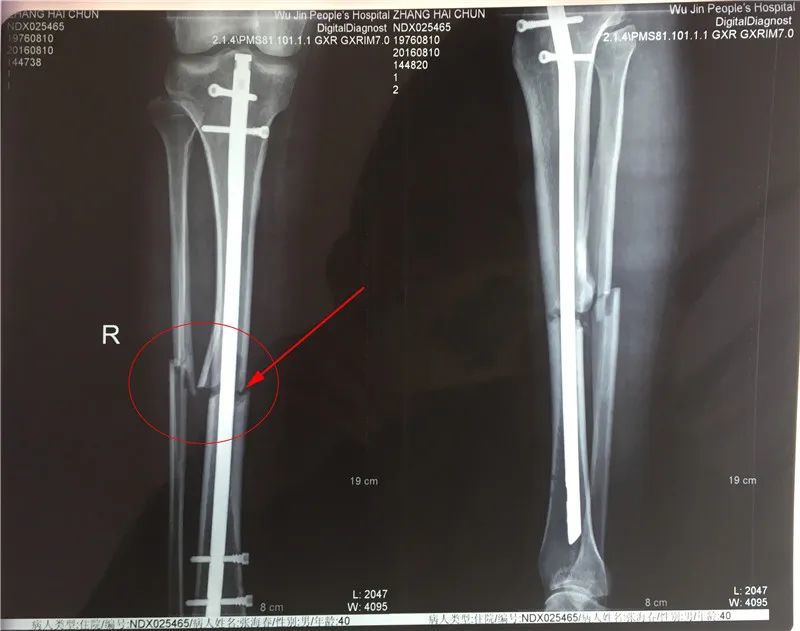6个月一点骨痂没有的骨不连,治疗后长骨痂是什么体验?