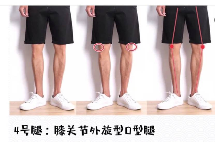 二,从膝盖到脚踝,形成一个o型大腿骨内旋,两个膝盖靠在一起走路; 三