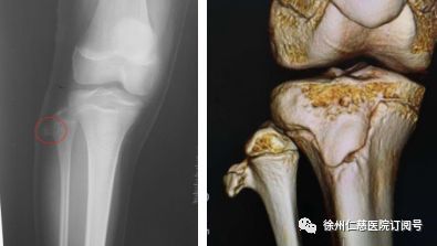 13岁少年右小腿出现红枣大小肿物 一查竟是骨软骨瘤 企业头条 天眼查