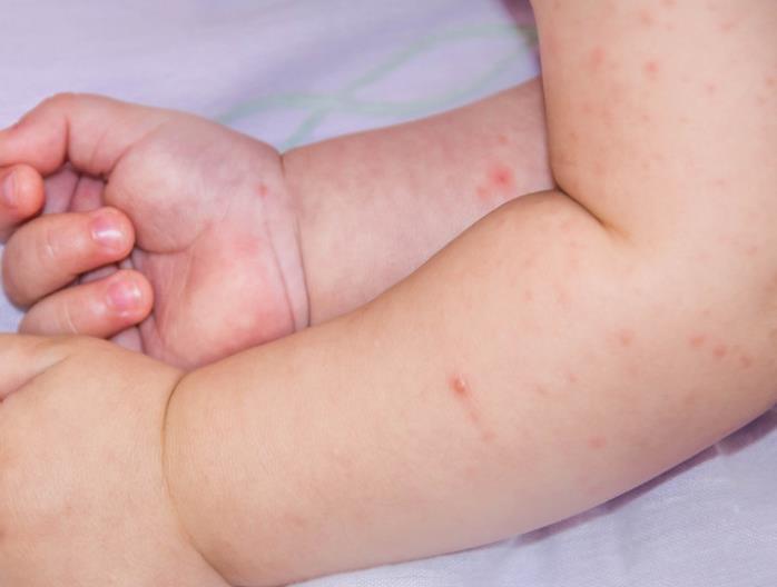 宝宝接种疫苗后,如果出现这8种不良反应,要赶紧送医院