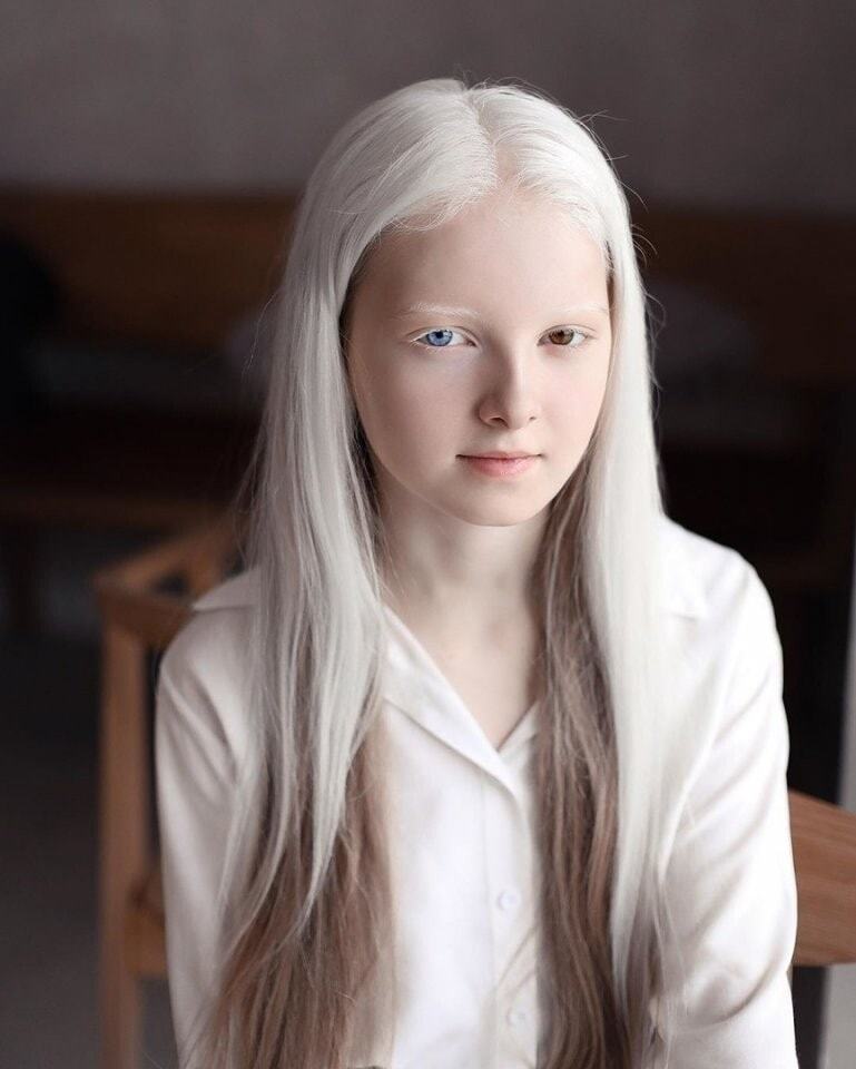 11岁美丽女孩天生白化病和异色瞳,美得像精灵,仿佛来自二次元!