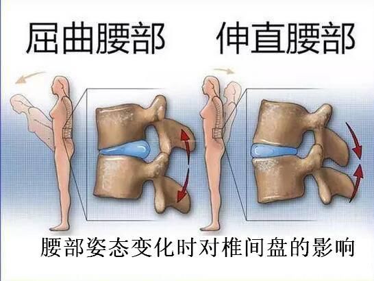 腰椎间盘膨出,突出和脱出!