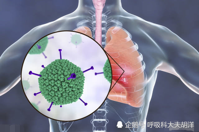 肺癌,肺结核以及肺炎,有区别也有关系,共同点:都可能威胁生命