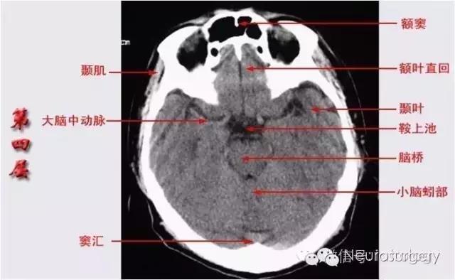 解剖&影像——颅脑ct解剖口诀及彩色解剖图