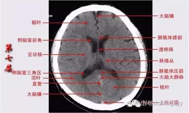 解剖&影像——颅脑ct解剖口诀及彩色解剖图