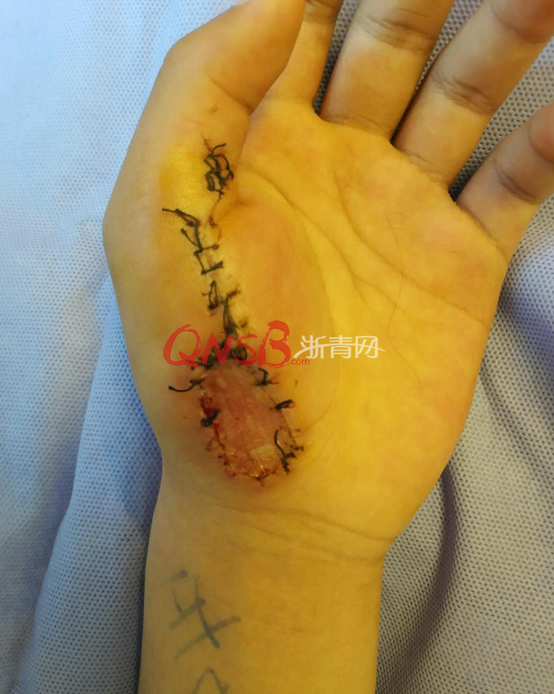 13岁少年挑战立扫把致手鲜血直流需住院治疗,这杀伤力医生也惊了