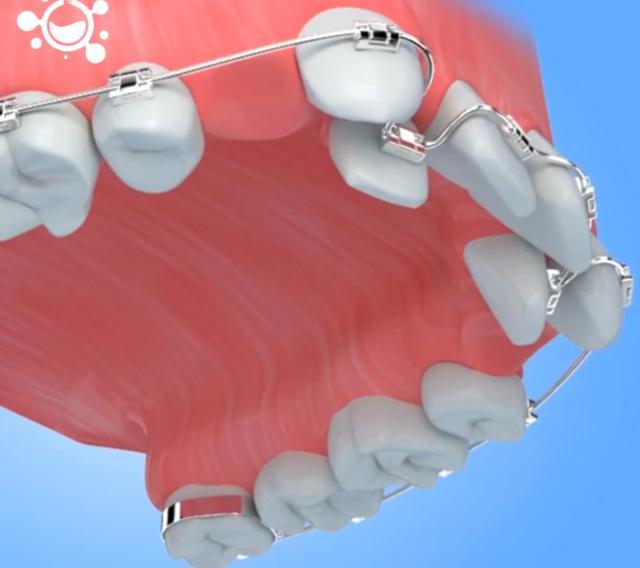 牙齿拥挤不齐,龅牙前突选金属牙套矫正,花钱少时间短性价比高