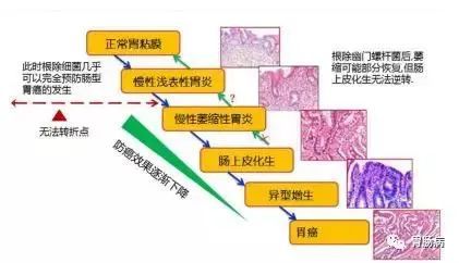 "萎缩","肠化"不是癌!别没病自己吓出病!