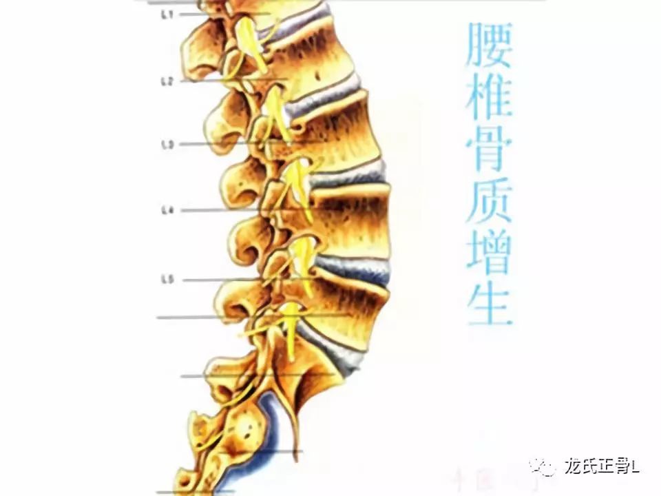 腰椎间盘,骨质增生,腰腿痛,脊柱
