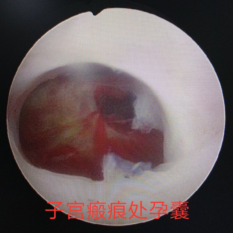 妇科首次成功运用宫腔镜技术治愈瘢痕妊娠