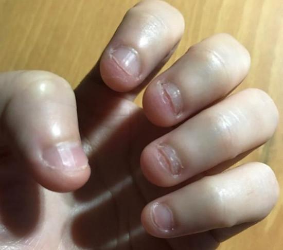 孩子,维生素,手指甲