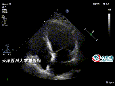 心动在线丨从一则非典型病例看超声心动图在冠心病诊疗中的价值