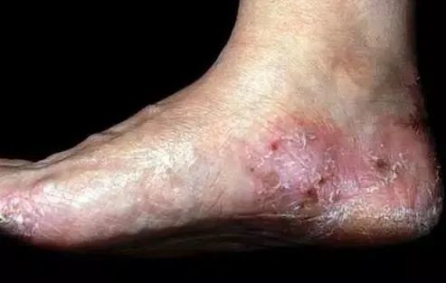 角化过度型脚癣 这类脚癣发生时,可以发现 脚底相应部位的皮肤显得很