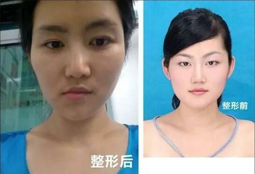 还记得当年贪便宜去韩国整容,却把脸整歪的女子吗?如今怎样?