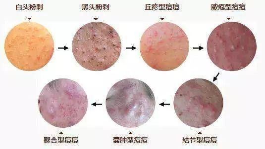 痘痘情况已经开始恶化,部分痘痘已经由丘疹恶化而转变为脓包,对皮肤