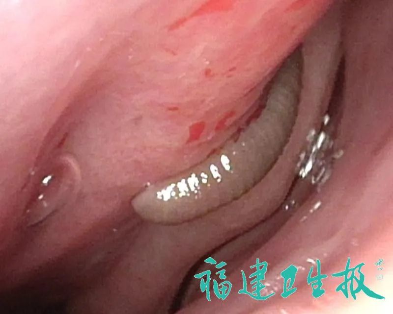 蚂蟥,鼻子,鼻腔,何观文,流鼻血