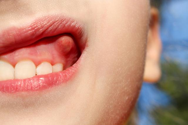 牙槽骨被破坏并吸收,脓疱在牙龈上隆起,从根尖到牙齿的根部形成瘘管