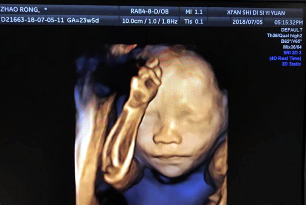 可当四维结果出炉后,看着胎宝宝的"彩超照",小陈却皱了眉:照片里胎儿