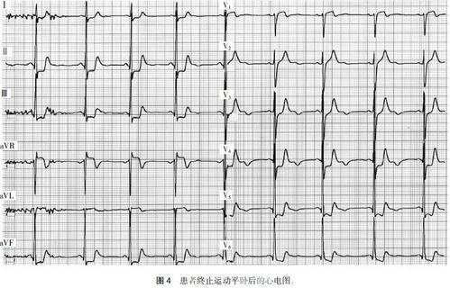心电图运动负荷试验结果判断标准