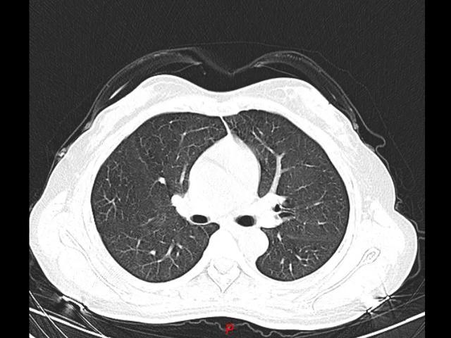 经过3天的抗过敏治疗后复查胸部ct,影像基本恢复正常!