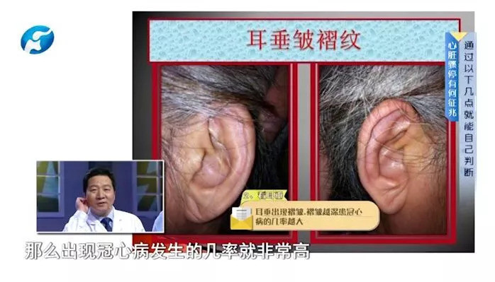 耳穴视诊:耳垂有一条折痕