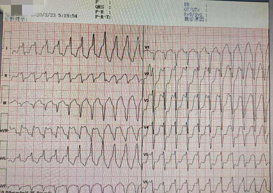 乌头碱中毒,心律失常,济宁医学院附属医院,室速,心电图
