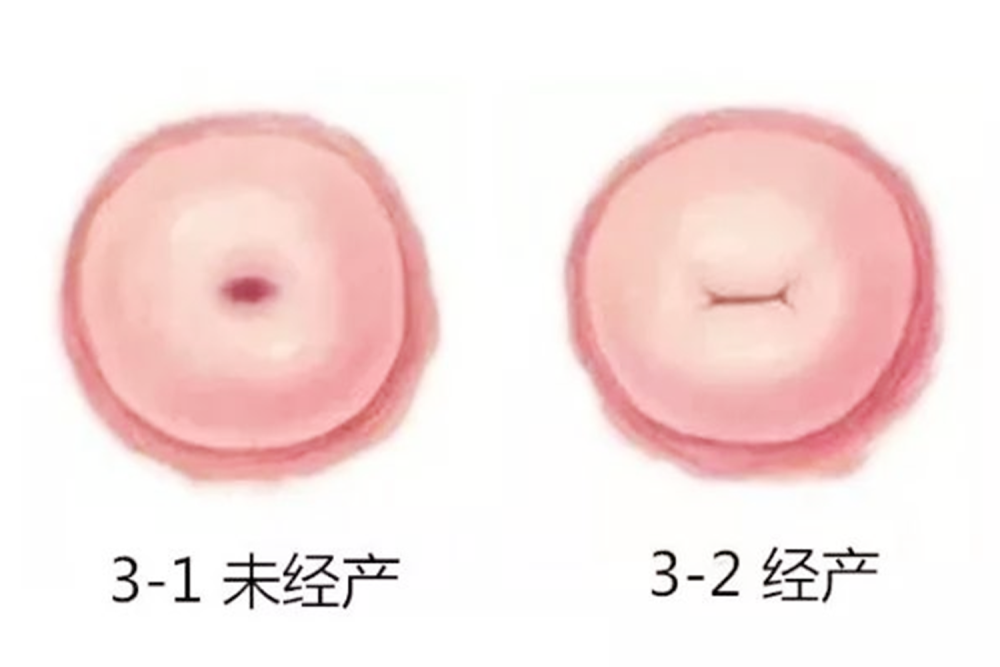 1) 宫颈口形状 生没生过孩子,最明显的区别就是宫颈口的形状.
