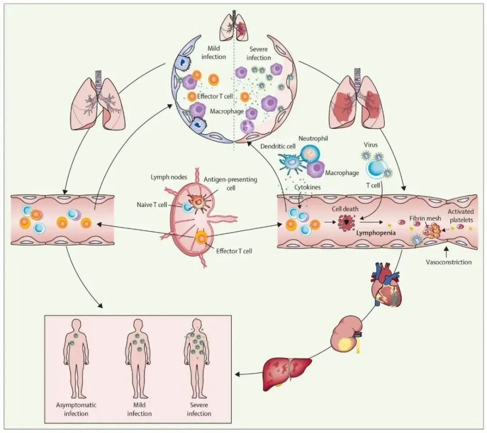《柳叶刀》:sars-cov-2 病毒性脓毒症——临床发现和科学假说