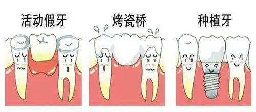 种植牙——选择适合自己的镶牙方法