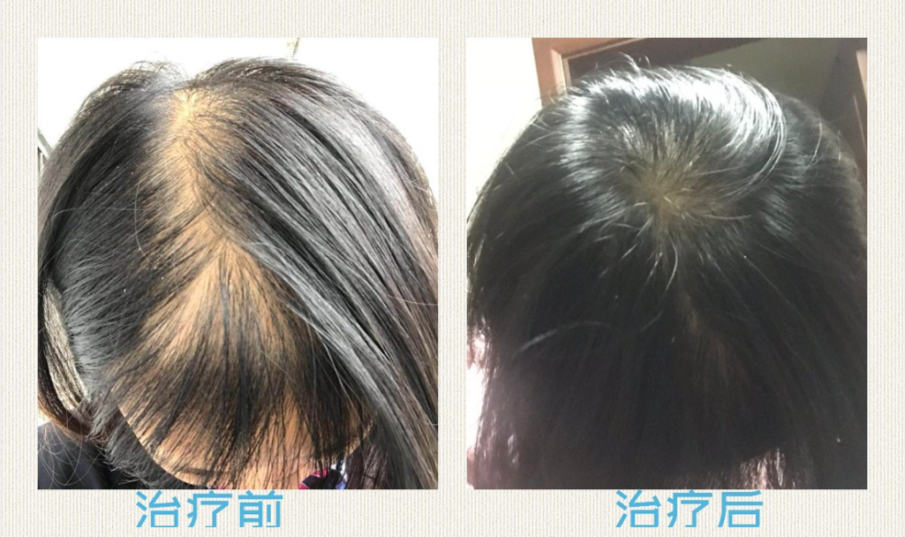 脱发也要分等级,你"脱"到了哪一级?