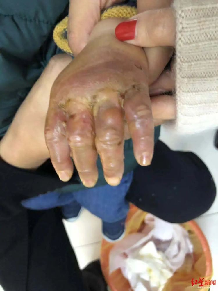 "狗子"妈妈发的孩子被烫伤的图片