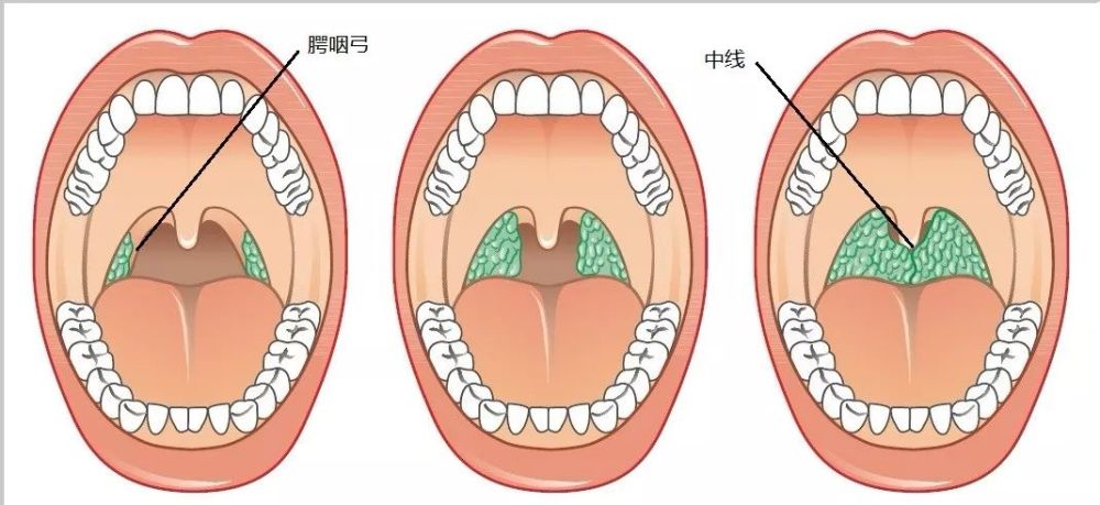 上图中间的表现; 如果超过中线或者两个扁桃体连接在一起,那就是三度